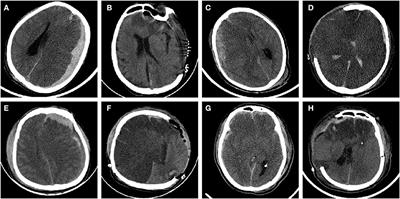 Predictive role of shock index in the early formation of cerebral infarction in patients with TBI and cerebral herniation